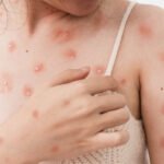 World Health Organization MonkeyPox Virus